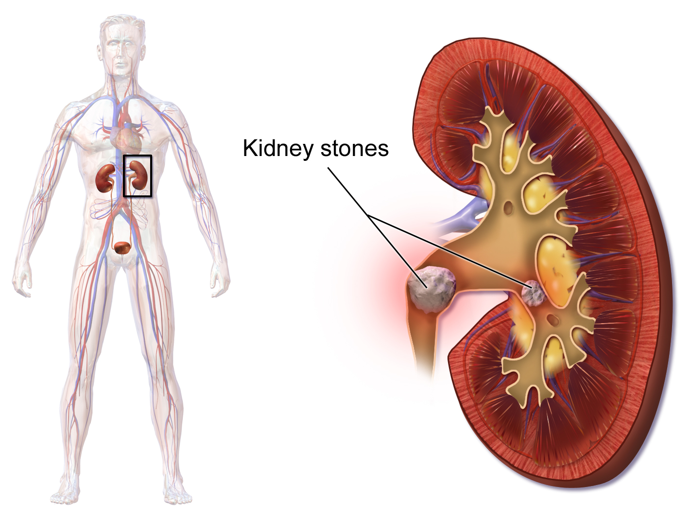 Kidney stones can be removed with Shatvari