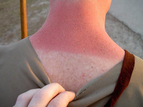 Everybody knows the rule of wearing sunscreen. However, people do forget. Be smart in the sun.