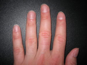 There are many common nail problems like splitting, peeling, and brittle nails, which can be caused due to long exposure to nails in water or due to strong soaps.