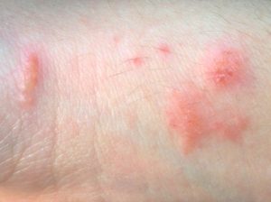 When you touch a scratch, scabs will form over the open wound, which is usually because you change shampoos, soaps or hair products.