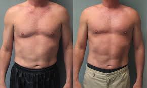 The effects of lipo can be very long-lasting so long as the patient’s weight does not greatly increase any time after the procedure. 