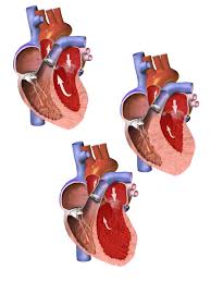 Heart weakening is the worst in Cardiomyopathy.