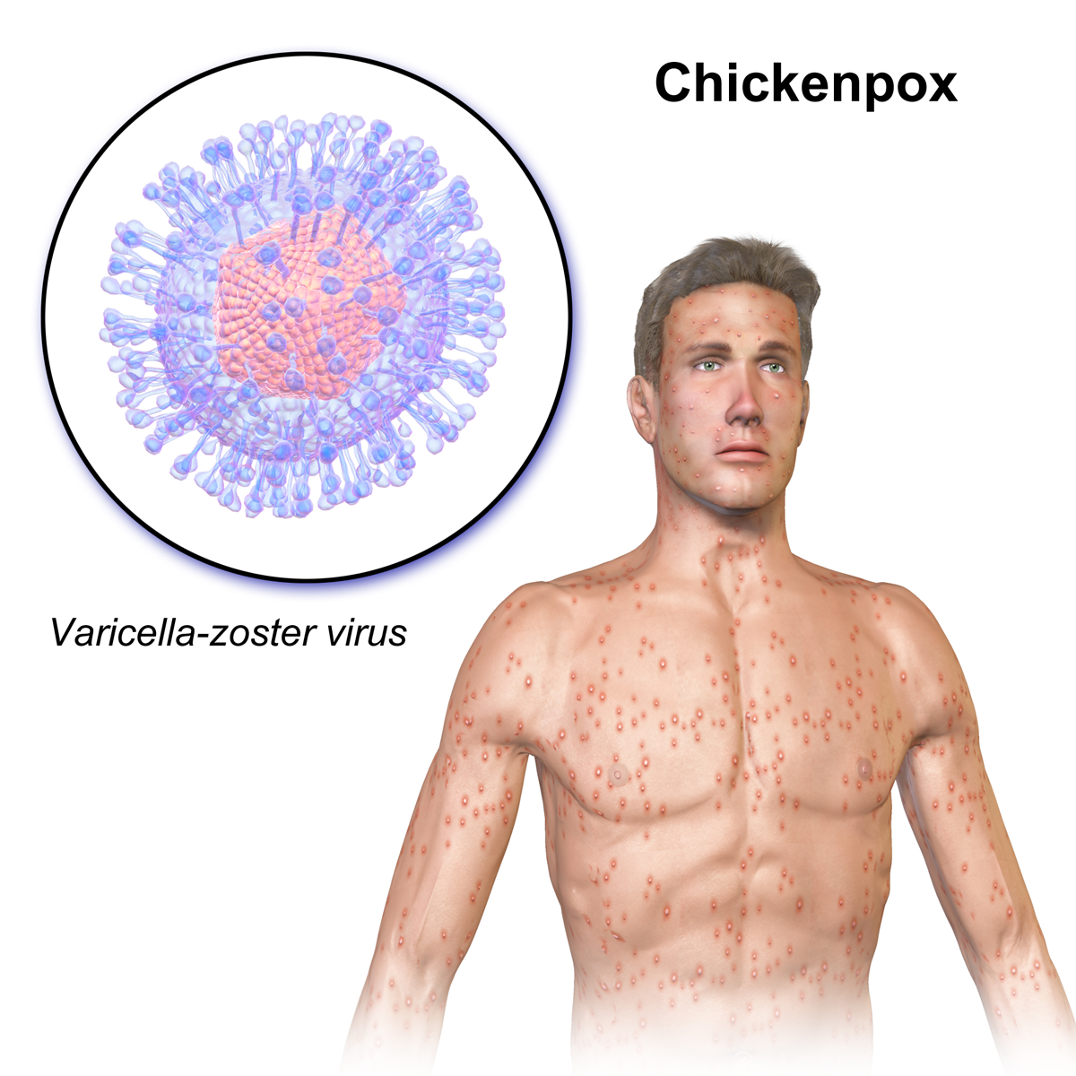 The itchy chickenpox rash appears after 1 to 2 days of symptoms.